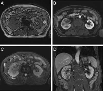 Case report: Sarcomatoid urothelial carcinoma of the renal pelvis masquerading as a renal abscess